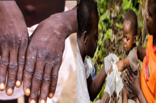 Variole du singe : le Gabon renforce son dispositif sanitaire